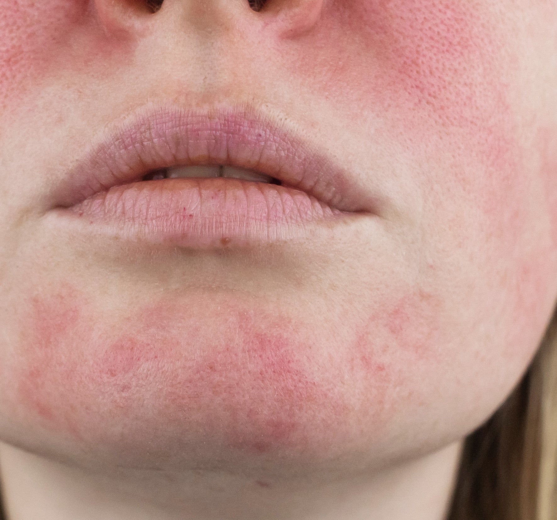 Hautpflege bei Neurodermitis mit Swiss Tallow Balm