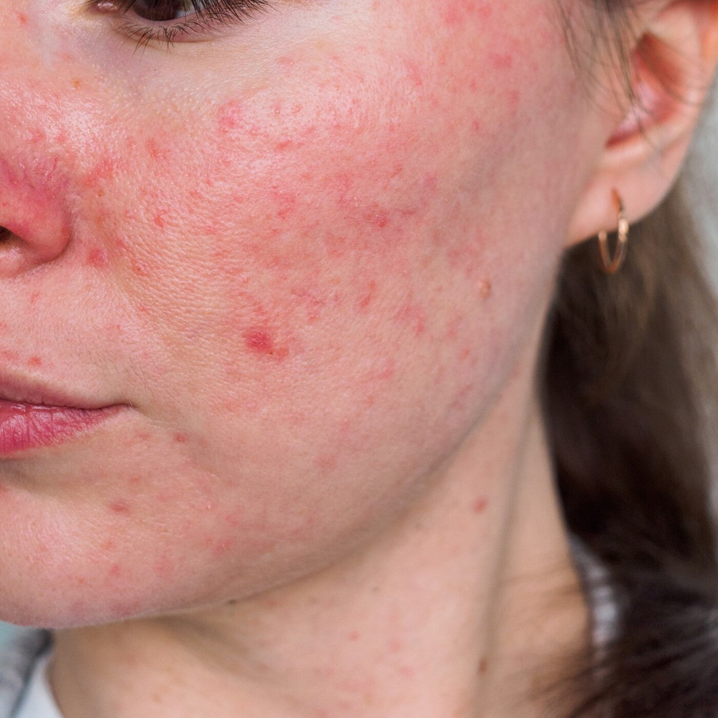 Frau mit stark geröteter, schuppiger Haut rund um Mund und Kinn