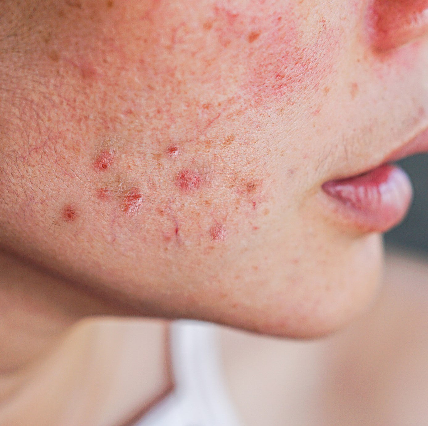 Frau betrachtet skeptisch ihre unreine Haut mit einzelnen Pickeln